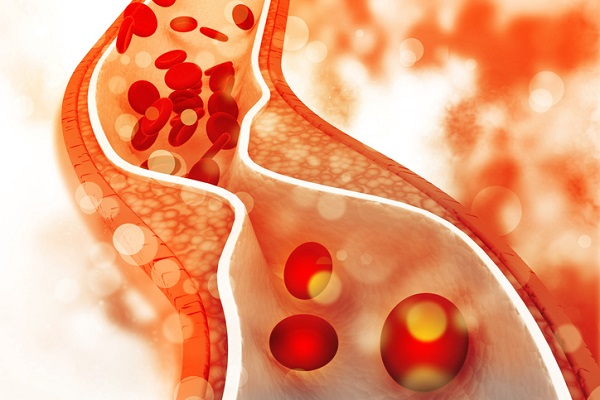Cholesterol levels affect artery health and high amounts can put people at risk for heart disease